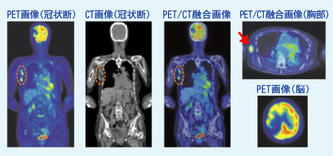 小浜病院乳がん（多発転移）がん検診(PET/CT検査)