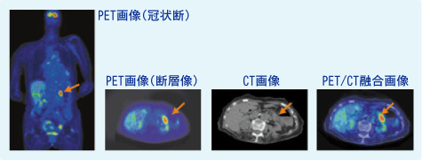 小浜病院膵がん（原発）がん検診(PET/CT検査)